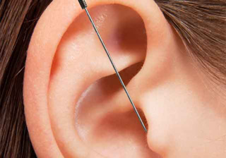 Ein Abbild aller Punkte findet sich im Ohr - Ohrakupunktur
