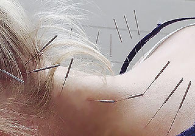 Hals, Schulter und Nacken mit Akupunktur behandeln