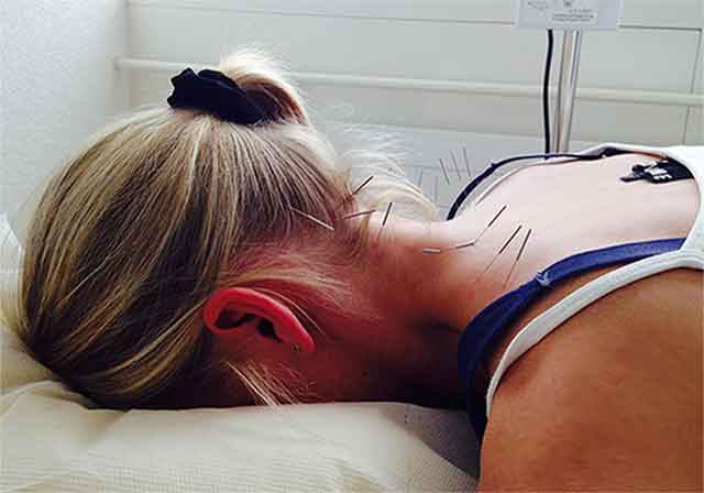 Am Halswirbel entlang mit Akupunktur behandeln